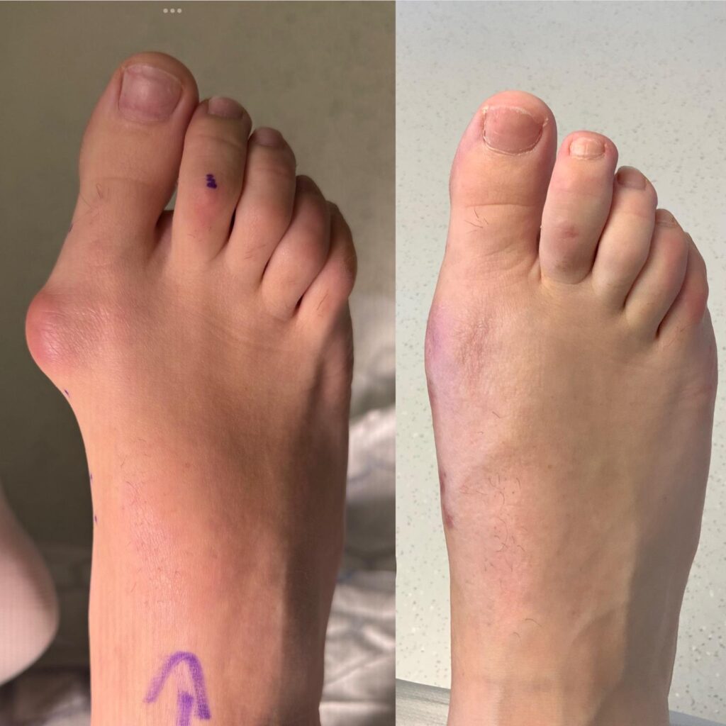 Kaser Nazir - Bunion Surgeon in Harley Street, London, Bunion Treatment Specialist
