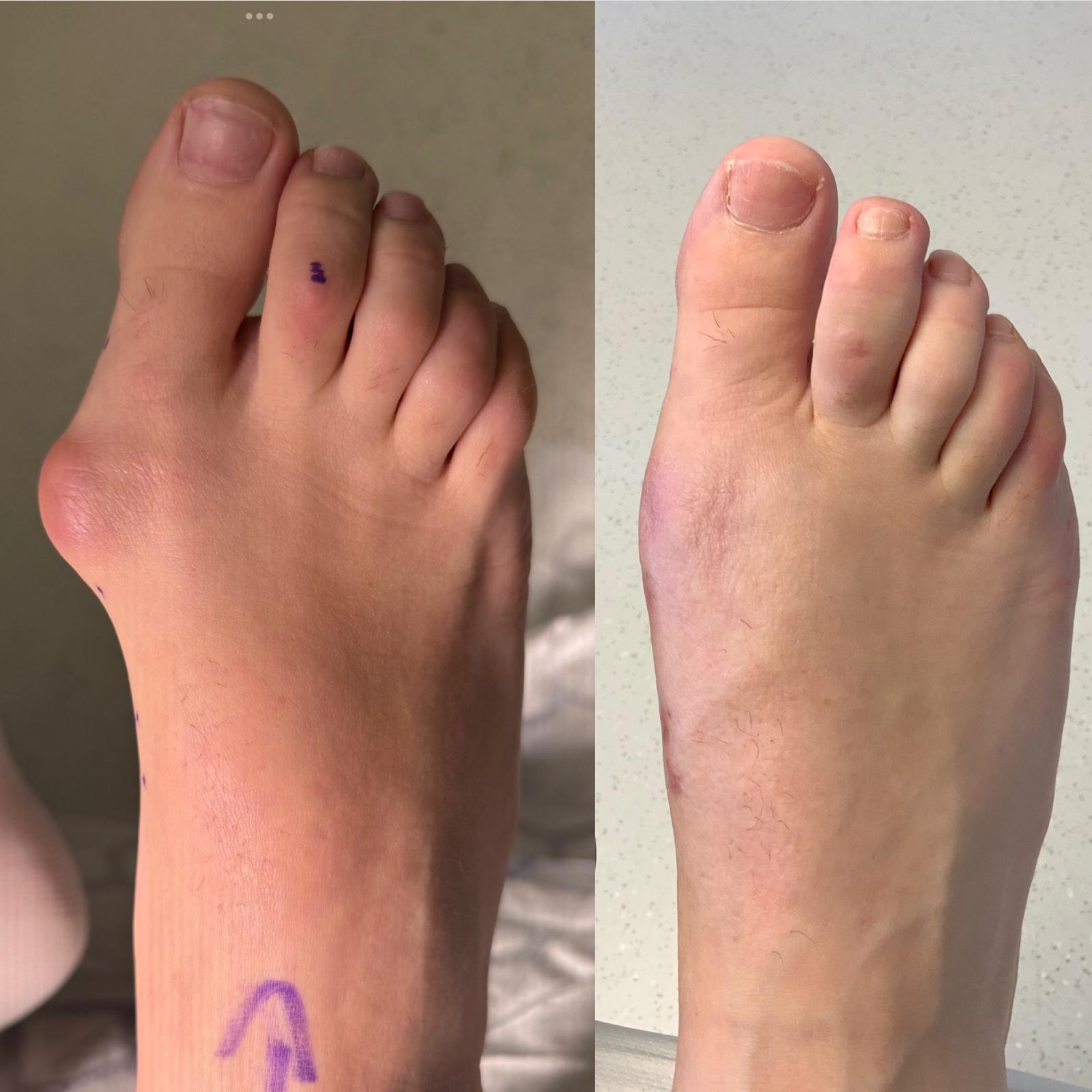 Kaser Nazir - Bunion Surgeon in Harley Street, London, Bunion Treatment Specialist