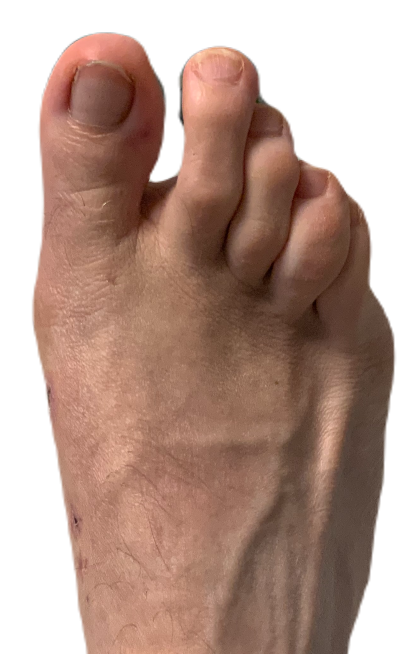 Kaser Nazir - Bunion Surgeon in Harley Street, London, Bunion Treatment Specialist