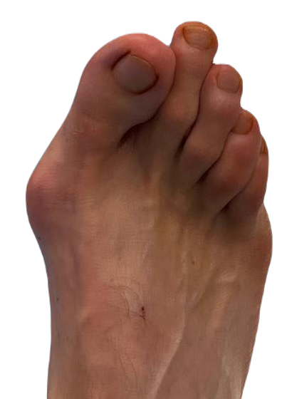 Kaser Nazir - Bunion Surgeon in Harley Street, London, Bunion Treatment Specialist