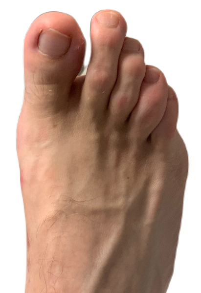 Kaser Nazir - Bunion Surgeon in Harley Street, London, Bunion Treatment Specialist