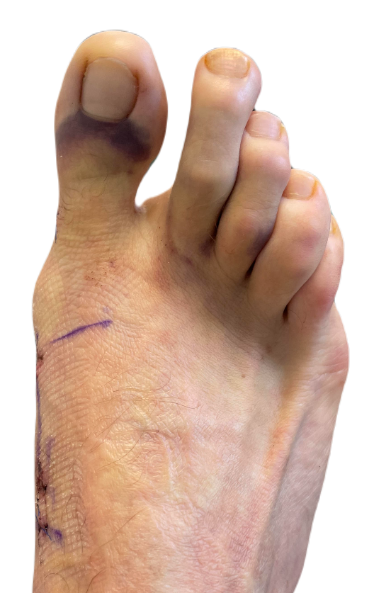 Kaser Nazir - Bunion Surgeon in Harley Street, London, Bunion Treatment Specialist