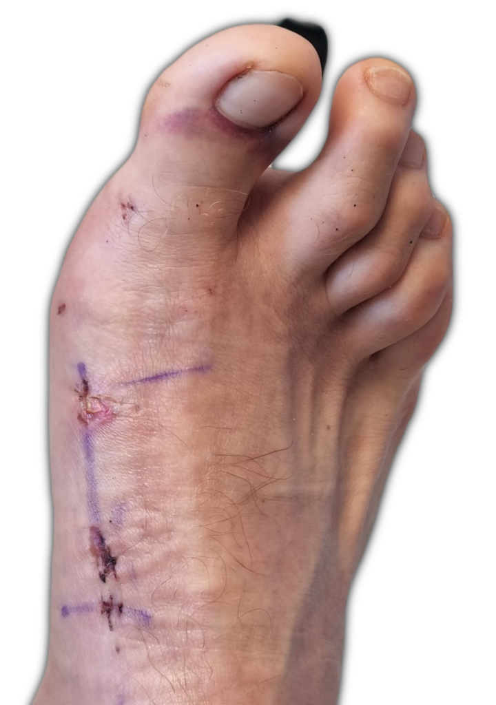 Kaser Nazir - Bunion Surgeon in Harley Street, London, Bunion Treatment Specialist