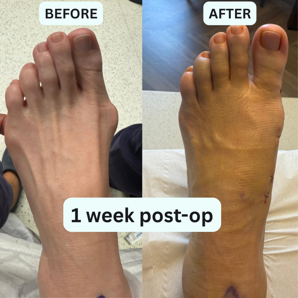 Left foot 1 week post-op