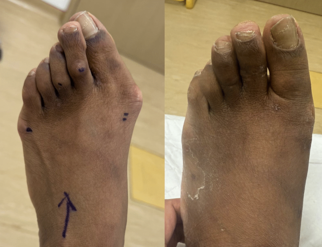 Bunion and Tailors - Kaser Nazir - Bunion Surgeon in Harley Street, London, Bunion Treatment Specialist