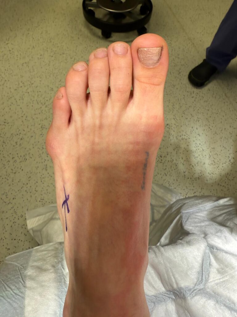 A tailor's bunion (or bunionette) - Kaser Nazir - Bunion Surgeon in Harley Street, London, Bunion Treatment Specialist