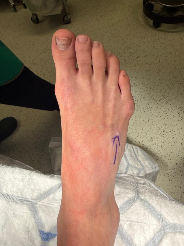 A tailor's bunion (or bunionette) - Kaser Nazir - Bunion Surgeon in Harley Street, London, Bunion Treatment Specialist