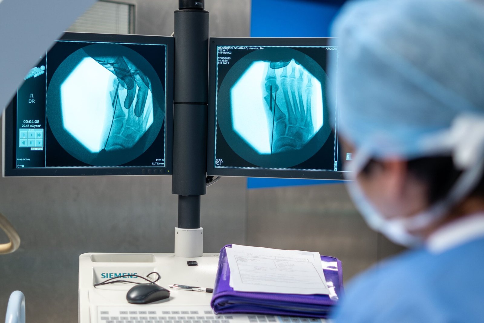 Bunion Recurrence After Surgery: Why It Happens and How to Prevent It